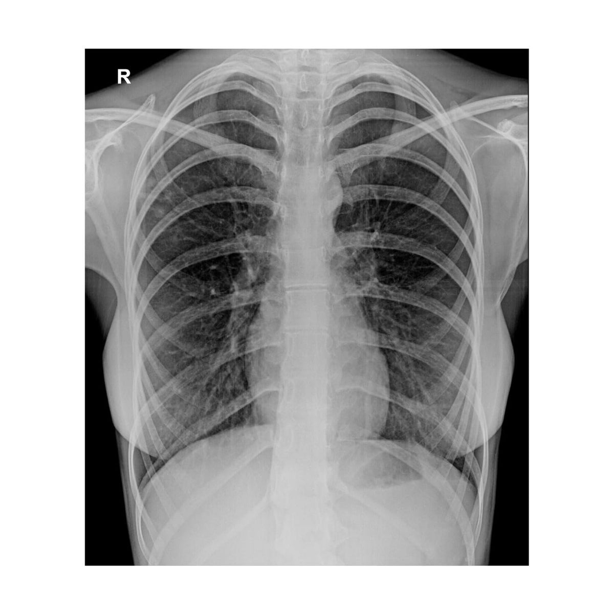 Blue Inkjet Xray Film | Size 11"×14" | Qty. 100 Films